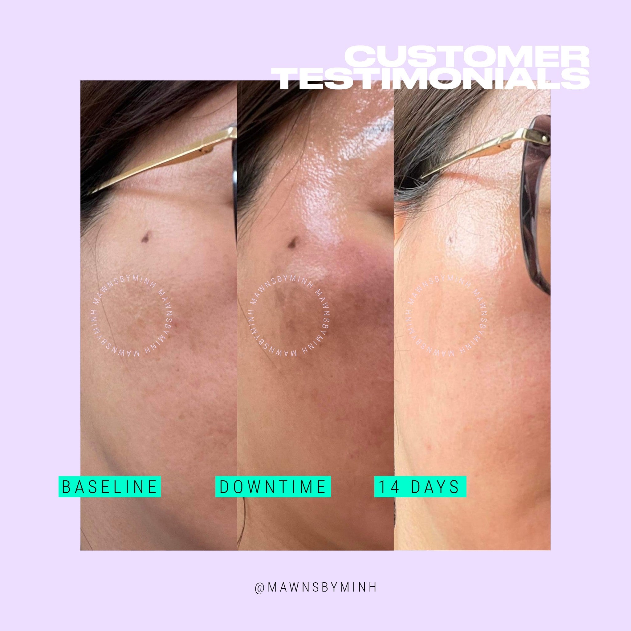 Innoaesthetics Inno-Exfo Lightening 15g